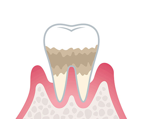 歯周炎（中度）