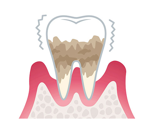 歯周炎（重度）